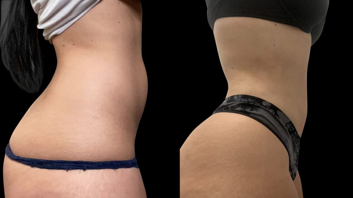 Liposuction Before & After Gallery - Patient 381027 - Image 2
