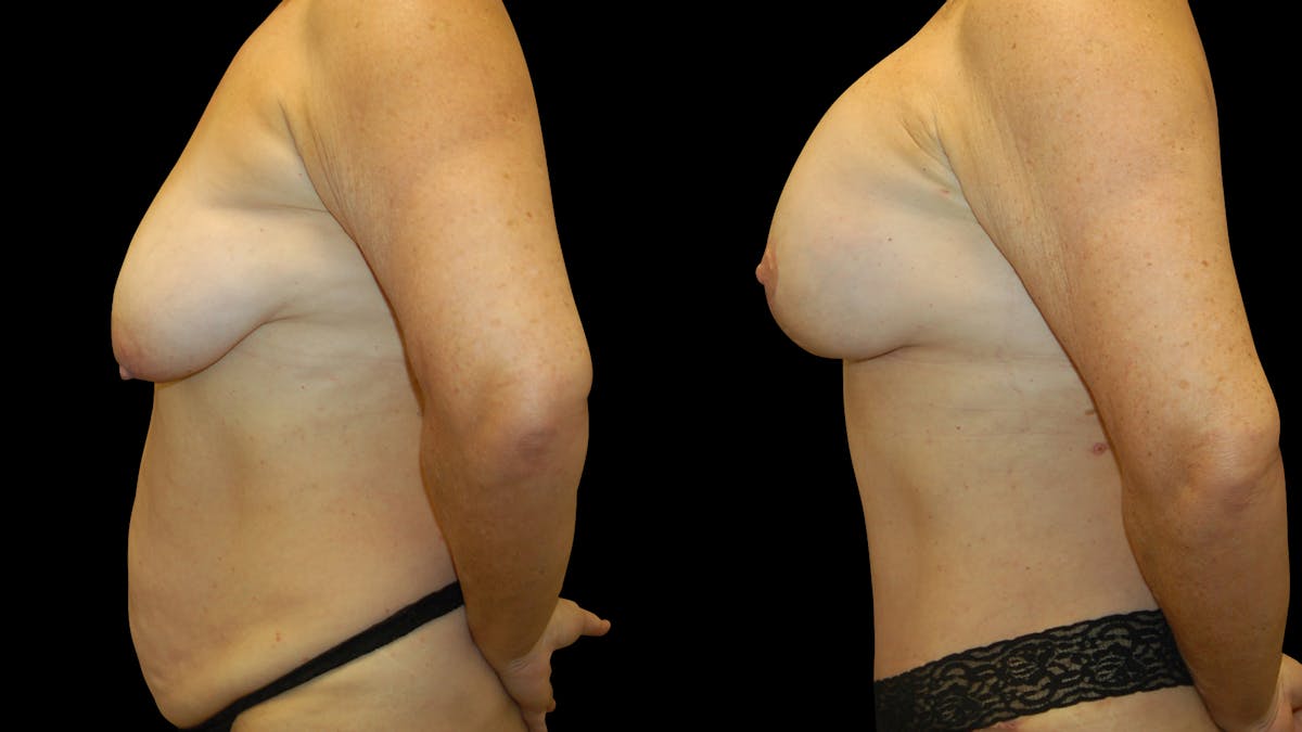 Mommy Makeover Before & After Gallery - Patient 362054 - Image 3