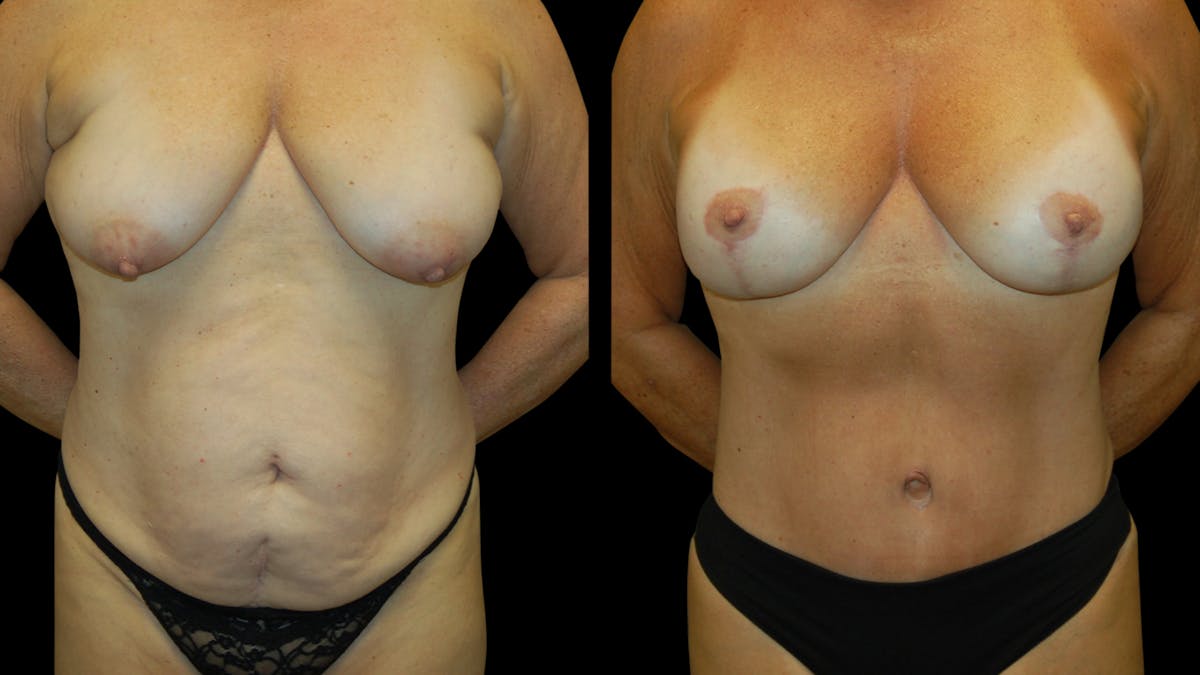 Mommy Makeover Before & After Gallery - Patient 362054 - Image 1