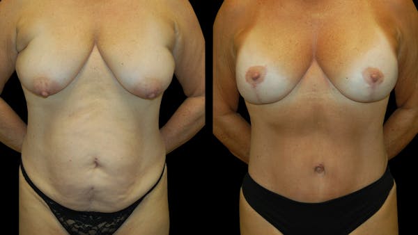 Mommy Makeover Before & After Gallery - Patient 362054 - Image 1