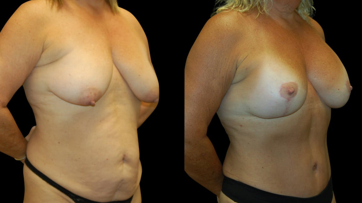 Mommy Makeover Before & After Gallery - Patient 362054 - Image 4
