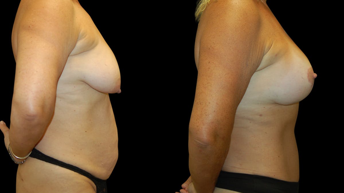 Mommy Makeover Before & After Gallery - Patient 362054 - Image 5