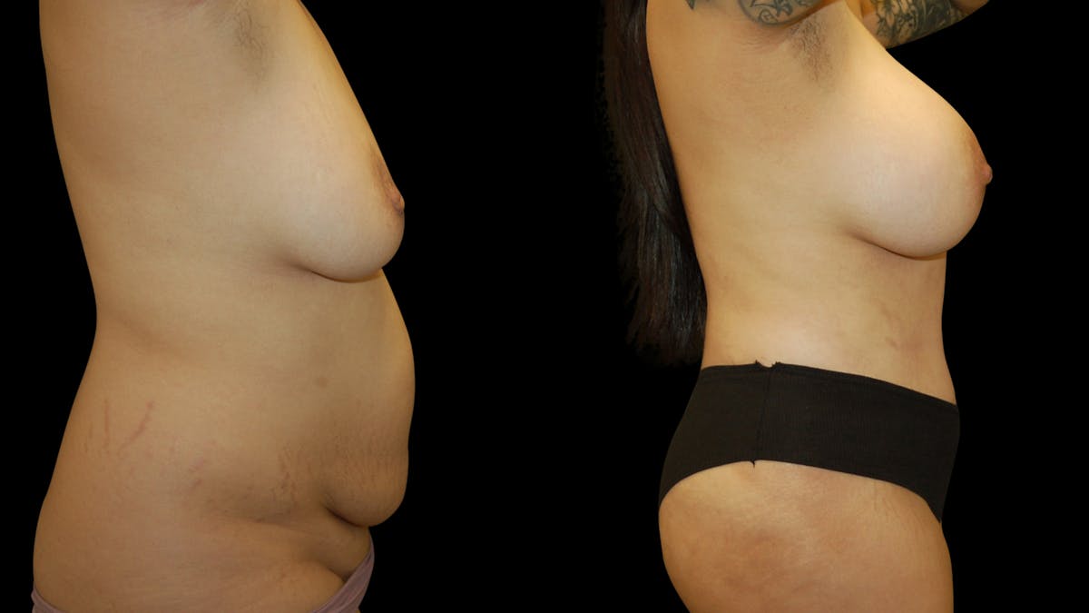 Mommy Makeover Before & After Gallery - Patient 146078 - Image 5