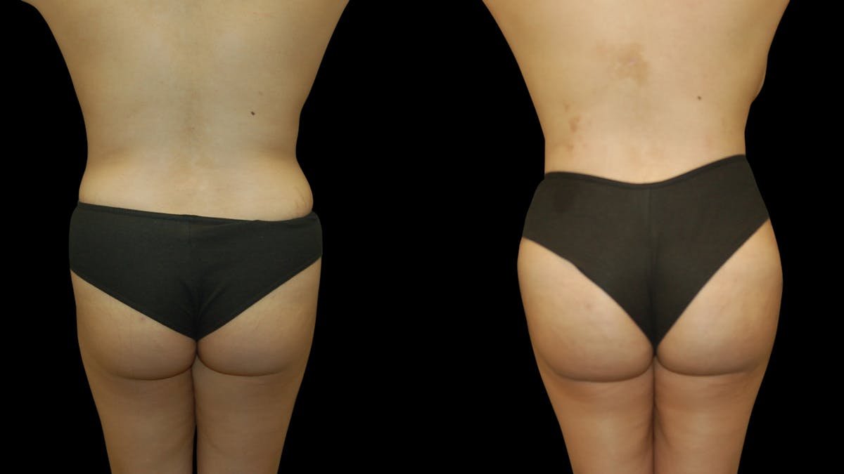 Mommy Makeover Before & After Gallery - Patient 146078 - Image 6