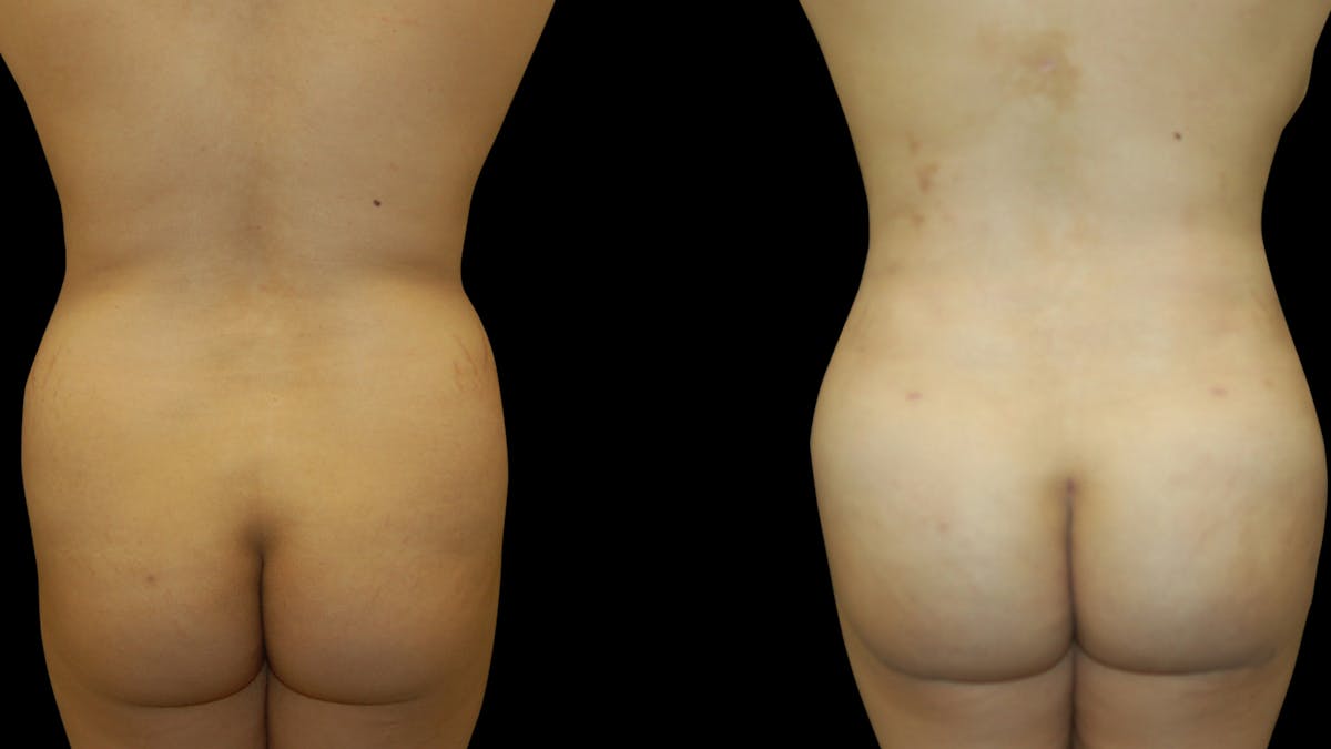Mommy Makeover Before & After Gallery - Patient 146078 - Image 7