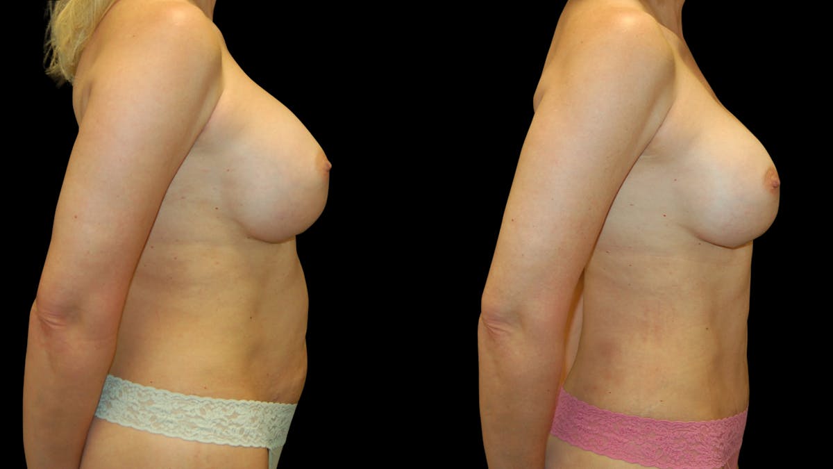 Mommy Makeover Before & After Gallery - Patient 370947 - Image 5