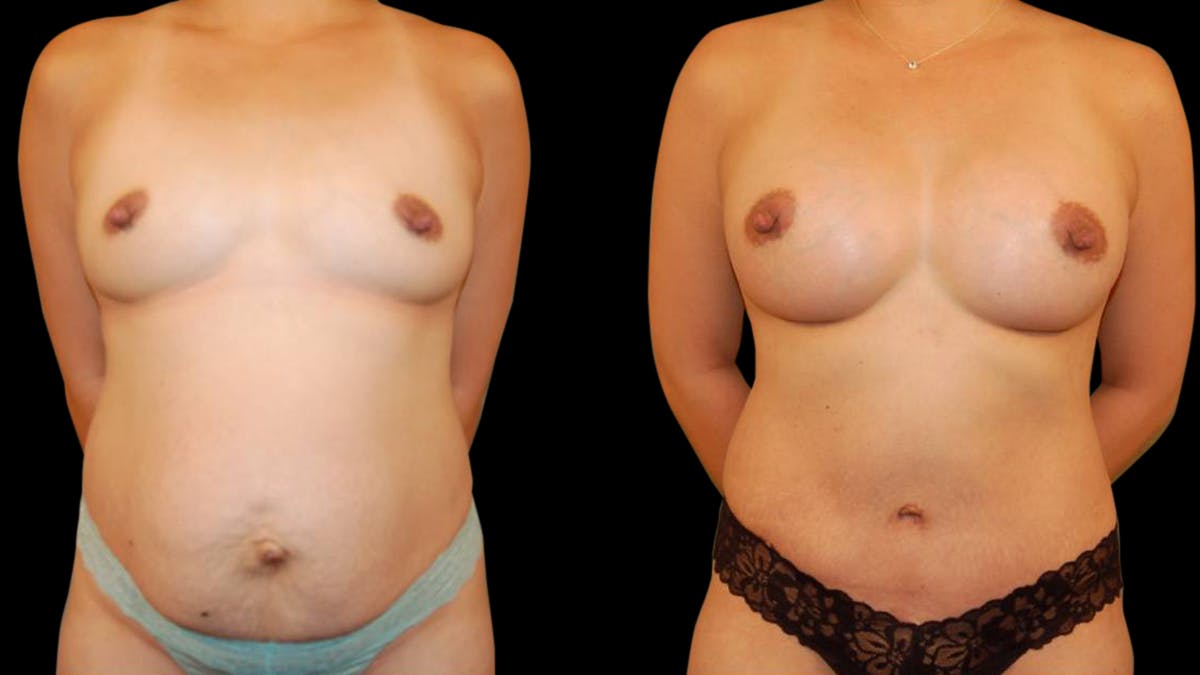 Tummy Tuck