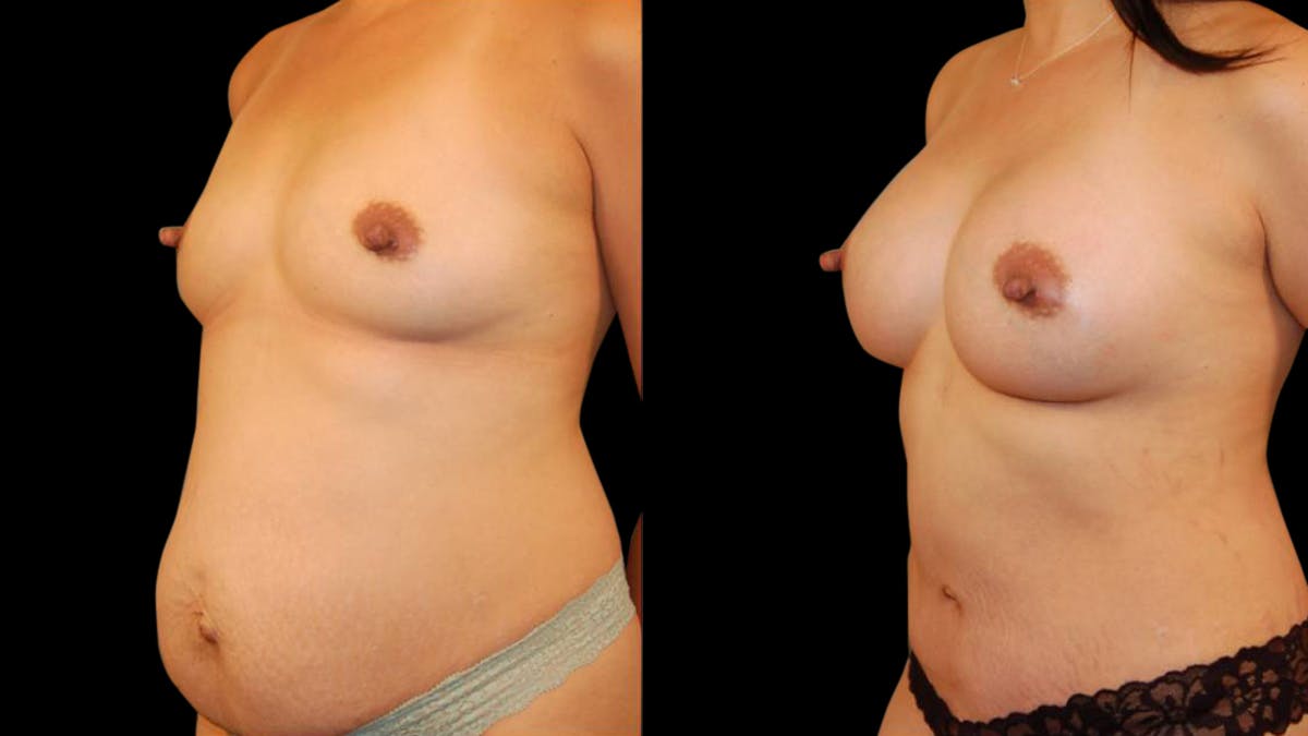 Mommy Makeover Before & After Gallery - Patient 325051 - Image 2