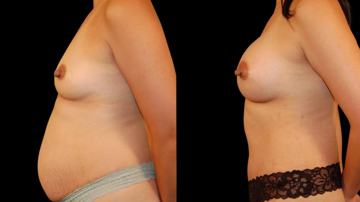 Mommy Makeover Before & After Gallery - Patient 325051 - Image 3