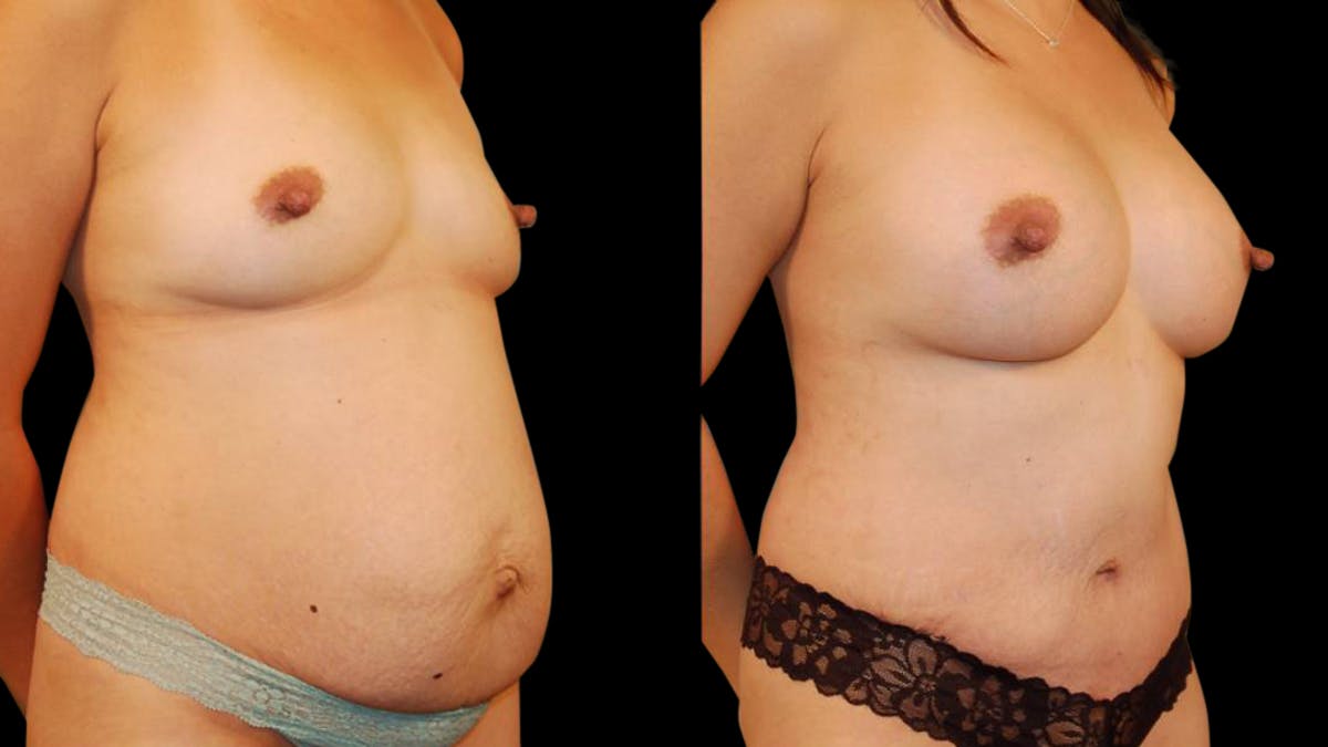 Mommy Makeover Before & After Gallery - Patient 325051 - Image 4