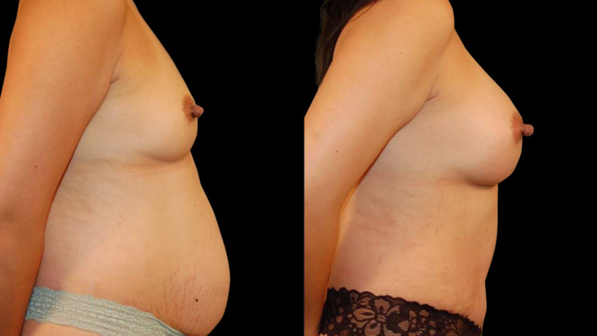 Mommy Makeover Before & After Gallery - Patient 325051 - Image 5