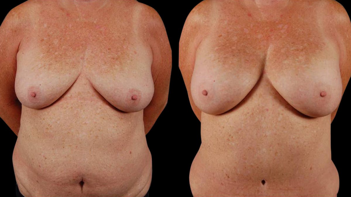 Mommy Makeover Before & After Gallery - Patient 107577 - Image 1