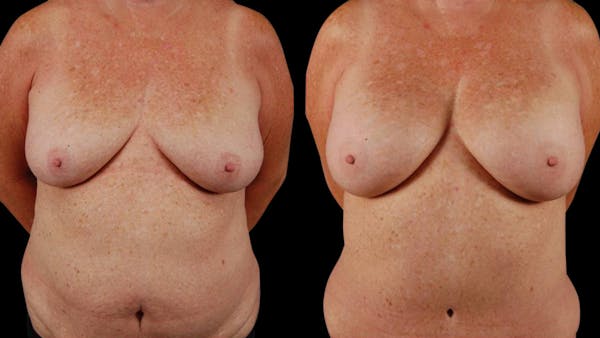 Mommy Makeover Before & After Gallery - Patient 107577 - Image 1