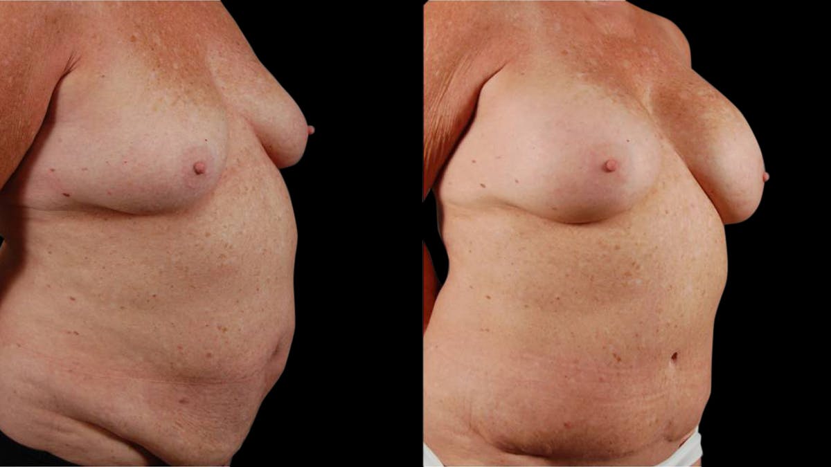 Mommy Makeover Before & After Gallery - Patient 107577 - Image 2
