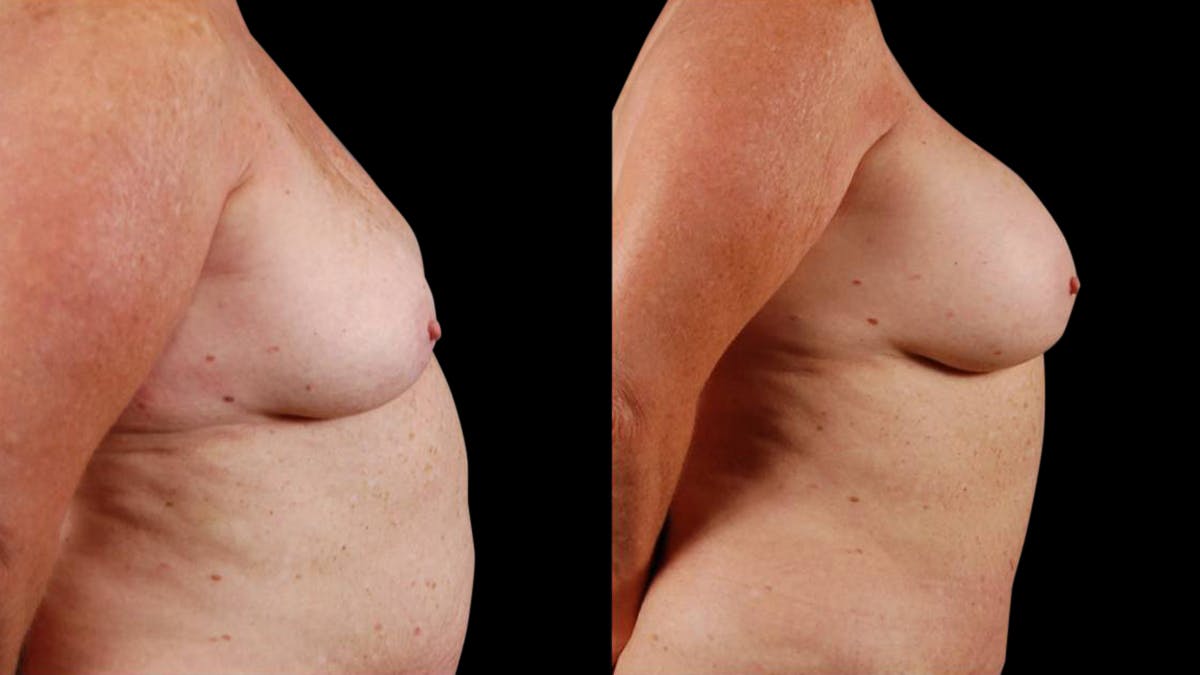 Mommy Makeover Before & After Gallery - Patient 107577 - Image 3