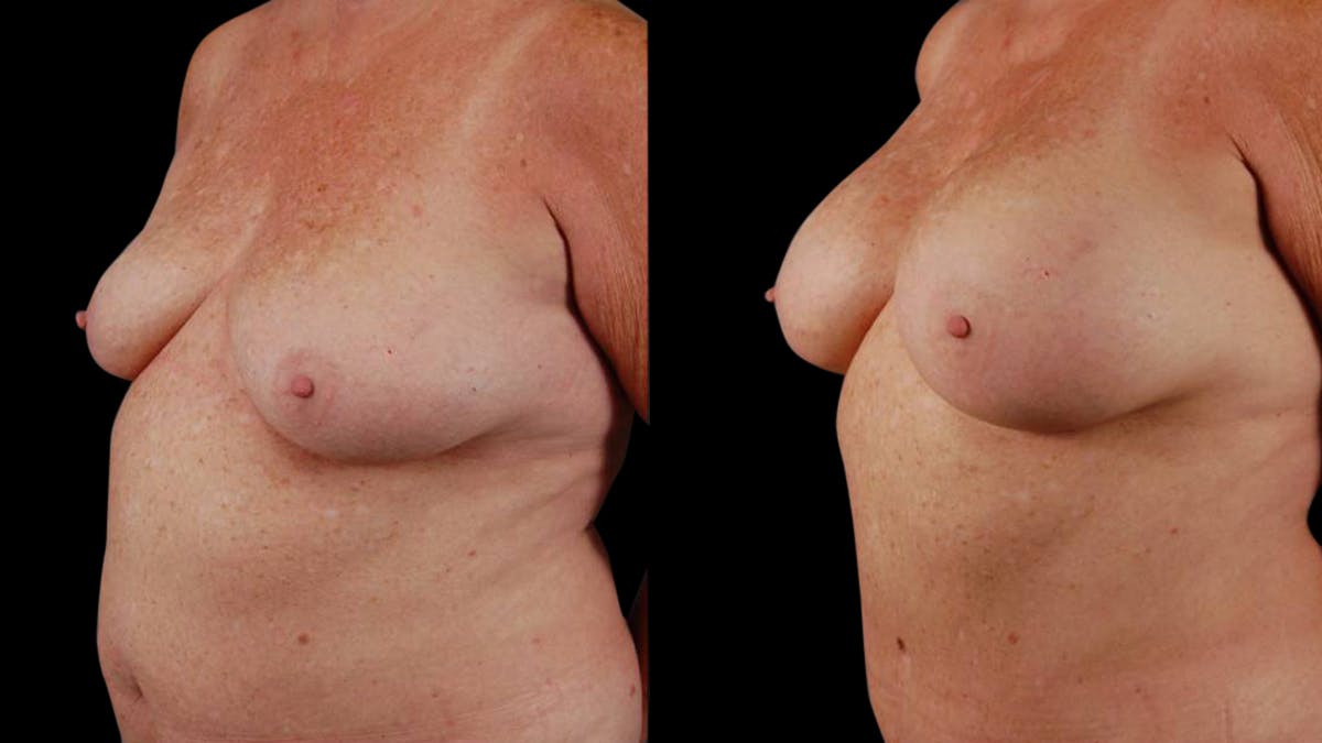 Mommy Makeover Before & After Gallery - Patient 107577 - Image 4