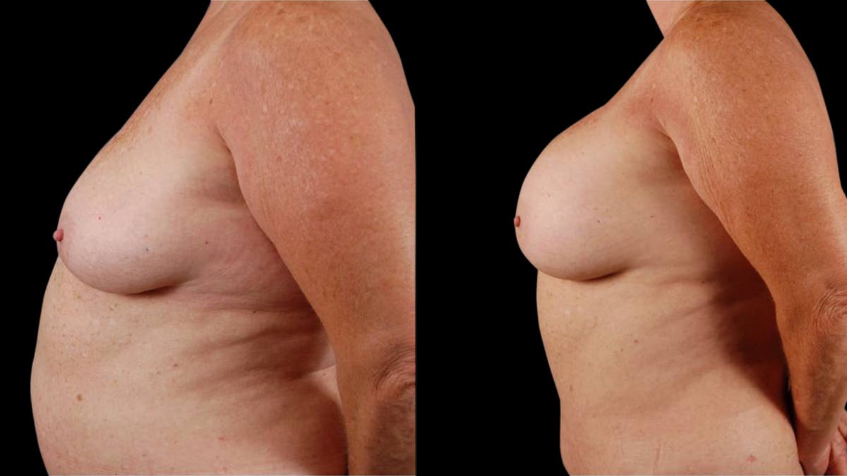 Mommy Makeover Before & After Gallery - Patient 107577 - Image 5