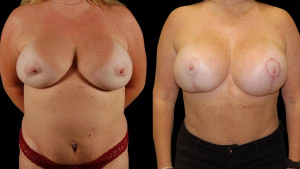Mommy Makeover Before & After Gallery - Patient 192926 - Image 1