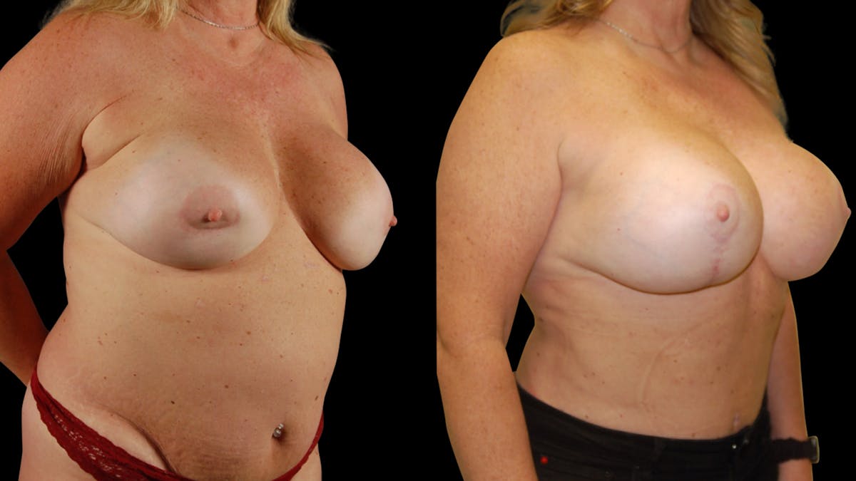 Mommy Makeover Before & After Gallery - Patient 192926 - Image 2