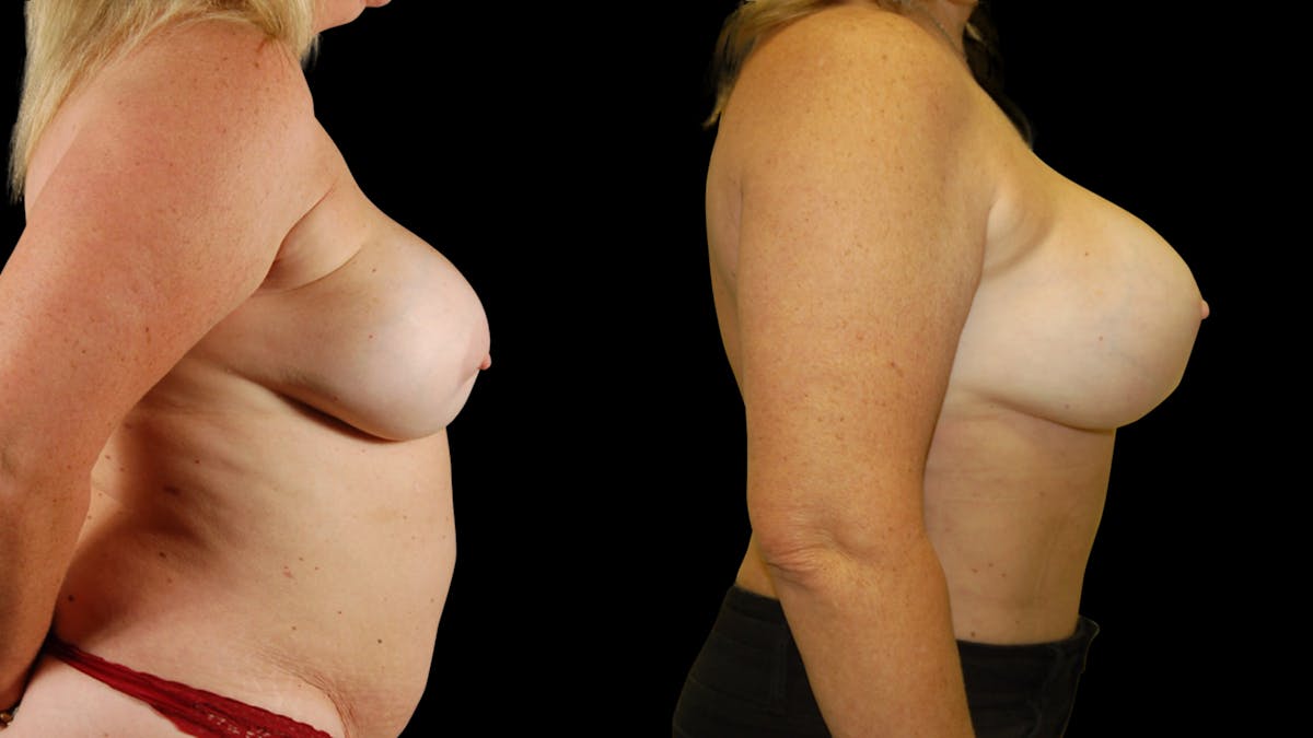 Mommy Makeover Before & After Gallery - Patient 192926 - Image 3