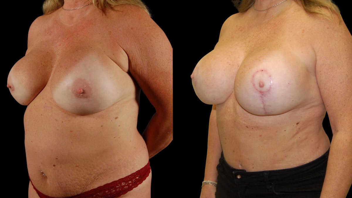 Mommy Makeover Before & After Gallery - Patient 192926 - Image 4
