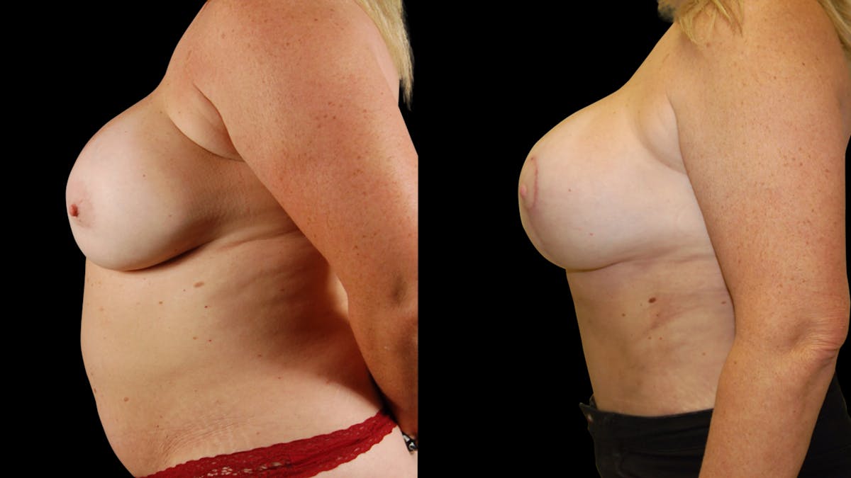 Mommy Makeover Before & After Gallery - Patient 192926 - Image 5