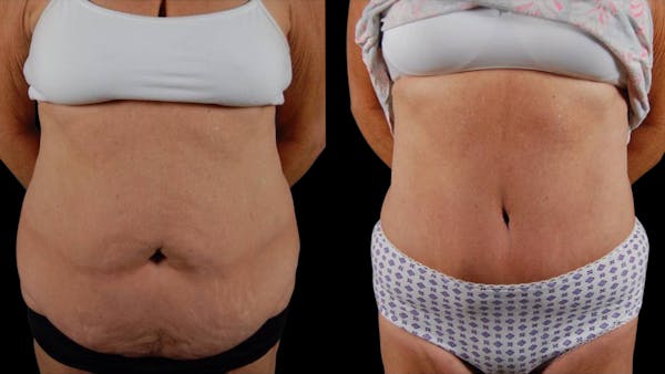 Mommy Makeover Before & After Gallery - Patient 265616 - Image 1