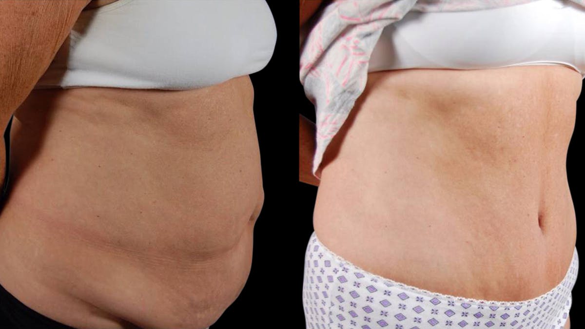Mommy Makeover Before & After Gallery - Patient 265616 - Image 2