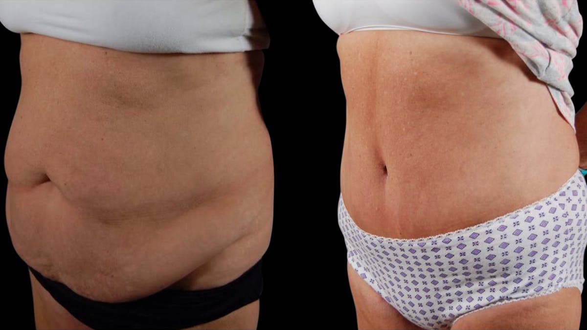 Mommy Makeover Before & After Gallery - Patient 265616 - Image 4