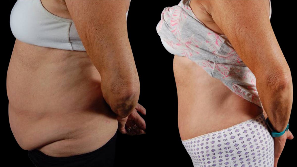 Mommy Makeover Before & After Gallery - Patient 265616 - Image 5