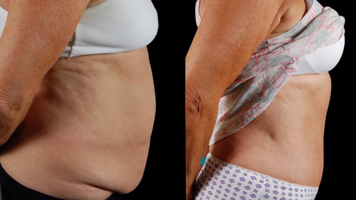 Mommy Makeover Before & After Gallery - Patient 265616 - Image 3