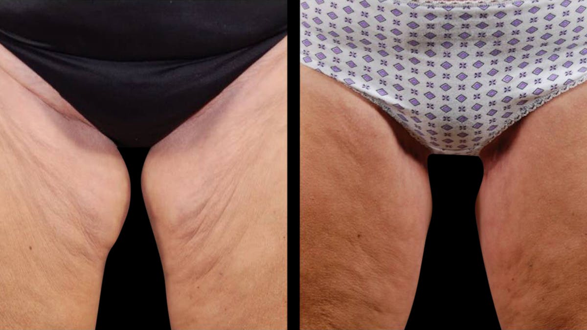 Mommy Makeover Before & After Gallery - Patient 265616 - Image 6