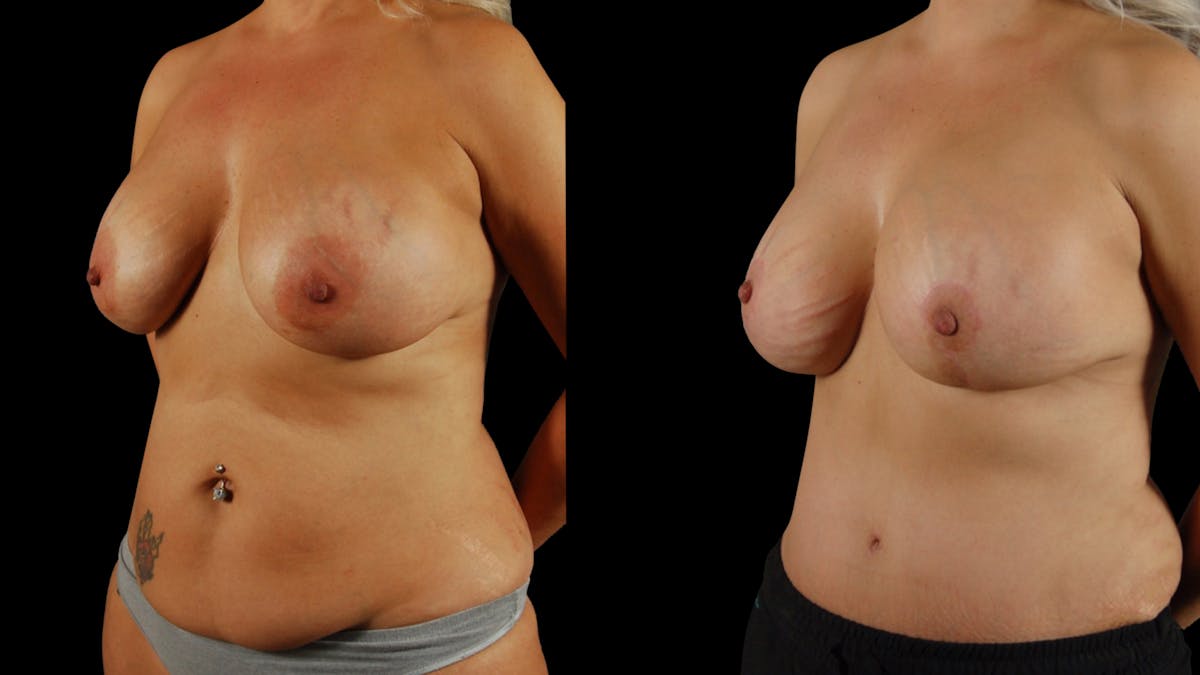 Mommy Makeover Before & After Gallery - Patient 266179 - Image 2