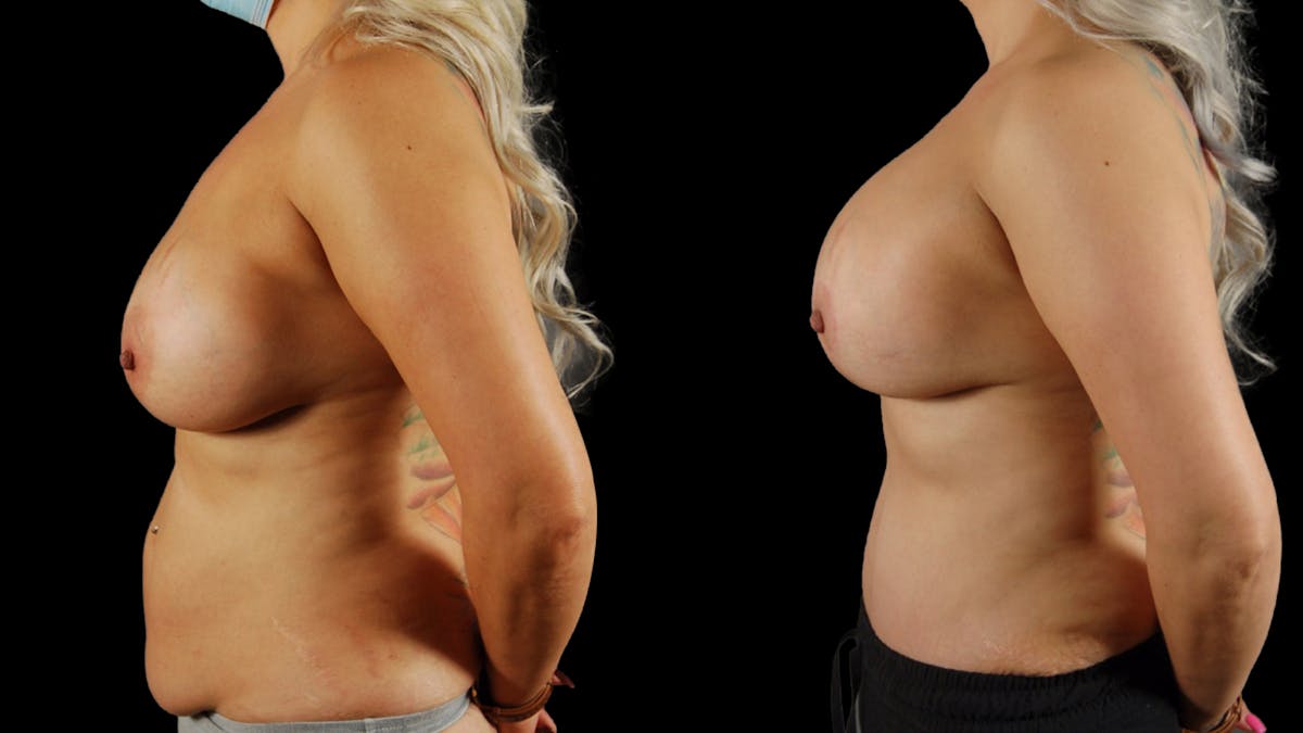 Mommy Makeover Before & After Gallery - Patient 266179 - Image 3