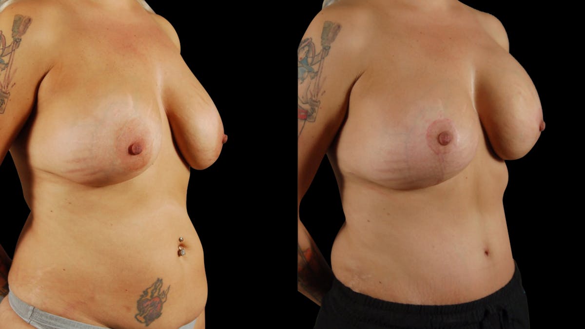 Mommy Makeover Before & After Gallery - Patient 266179 - Image 4