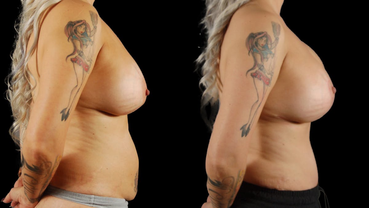 Mommy Makeover Before & After Gallery - Patient 266179 - Image 5