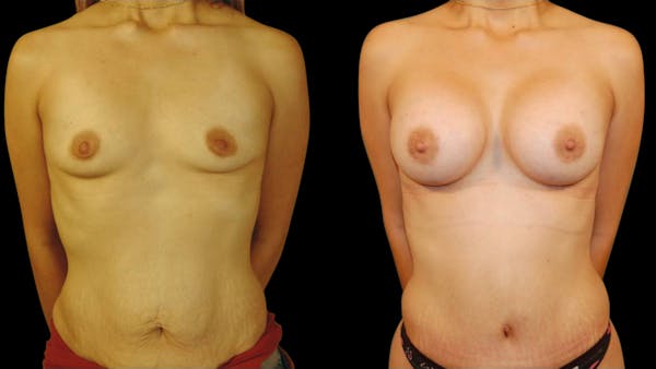 Mommy Makeover Before & After Gallery - Patient 221742 - Image 1
