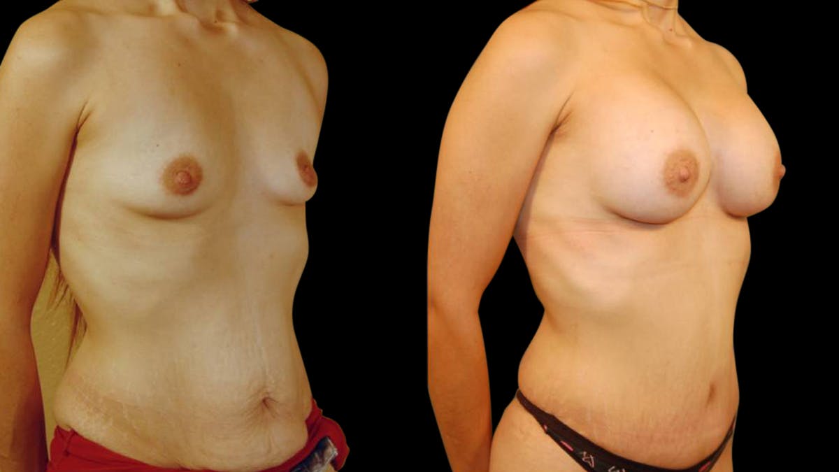 Mommy Makeover Before & After Gallery - Patient 221742 - Image 2