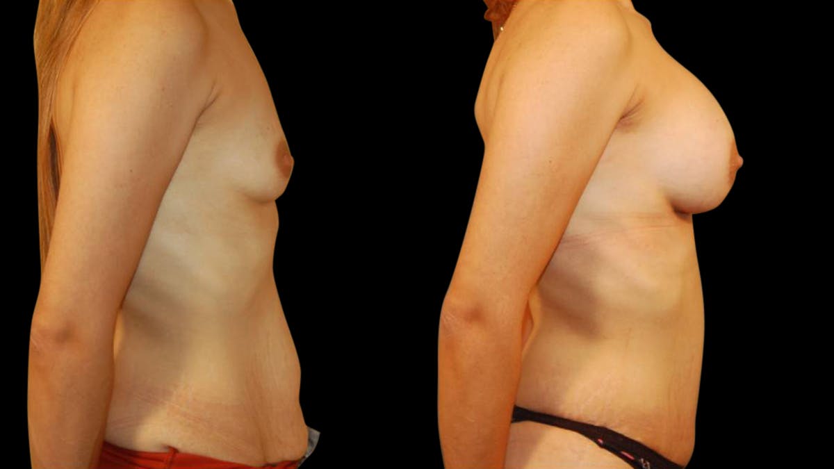 Mommy Makeover Before & After Gallery - Patient 221742 - Image 3