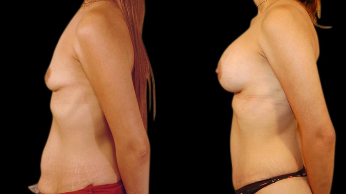 Mommy Makeover Before & After Gallery - Patient 221742 - Image 5