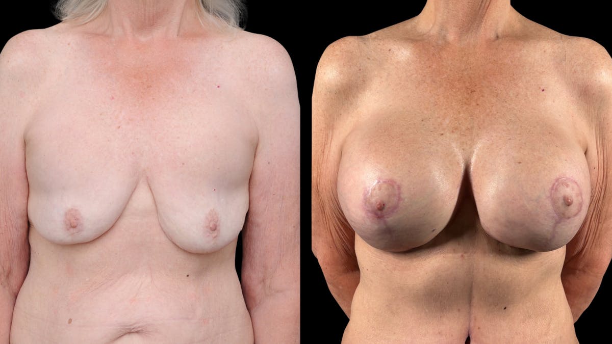 Mommy Makeover Before & After Gallery - Patient 536048 - Image 1