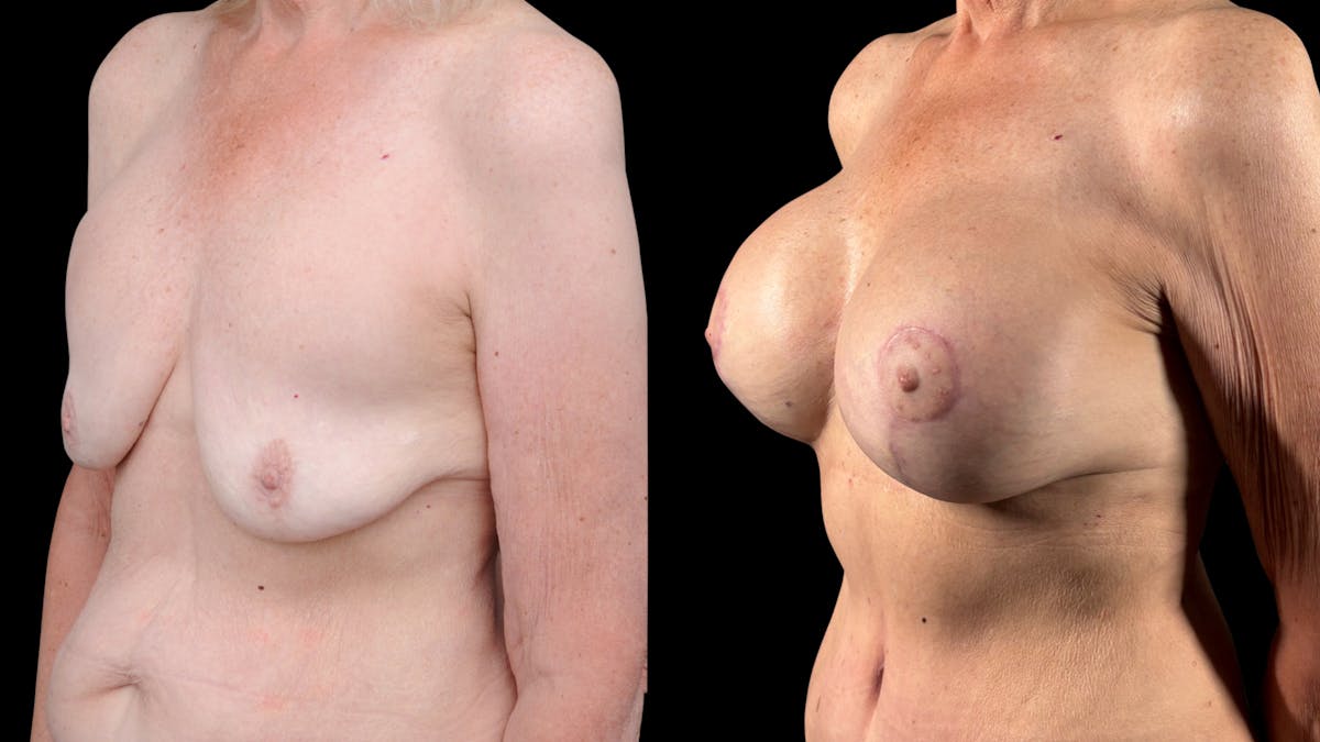 Mommy Makeover Before & After Gallery - Patient 536048 - Image 2