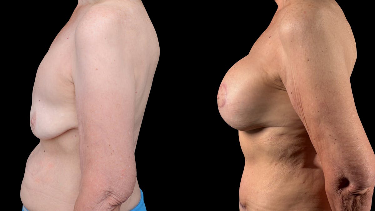Mommy Makeover Before & After Gallery - Patient 536048 - Image 3