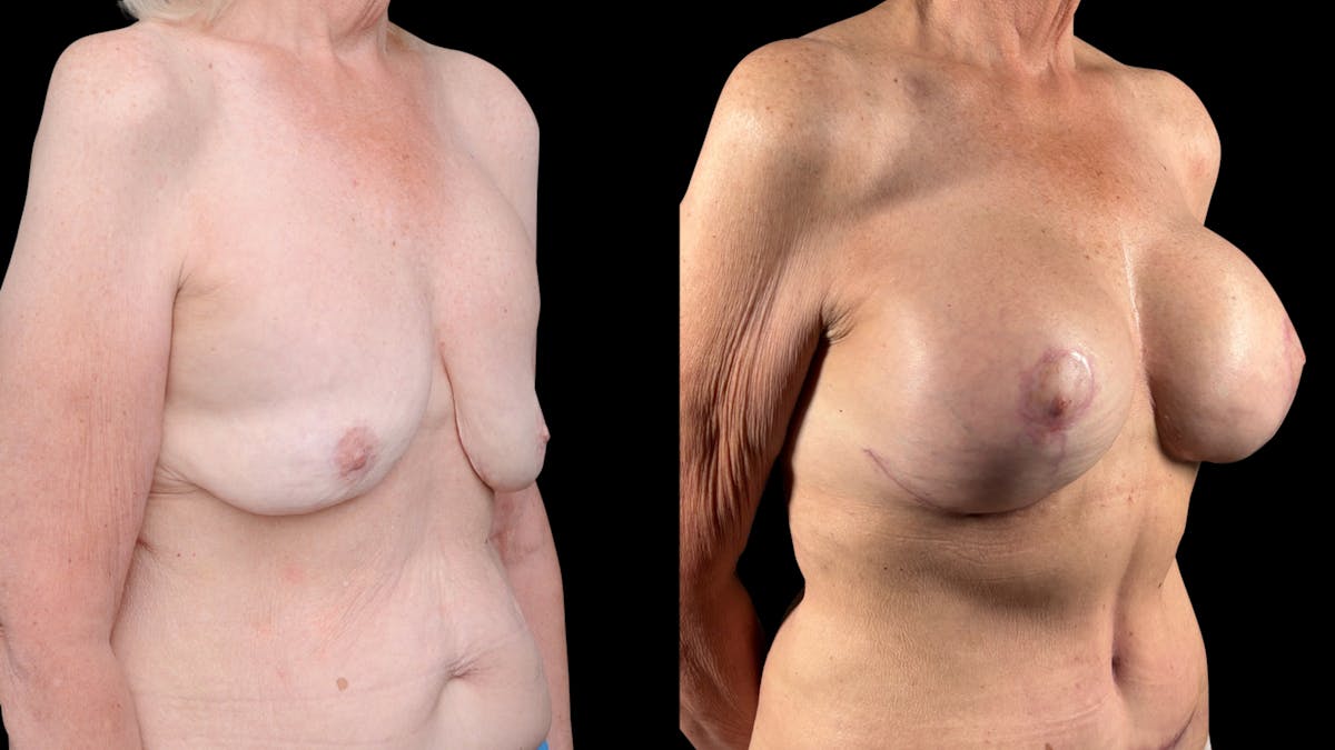 Mommy Makeover Before & After Gallery - Patient 536048 - Image 4