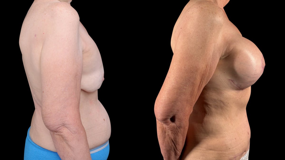 Mommy Makeover Before & After Gallery - Patient 536048 - Image 5