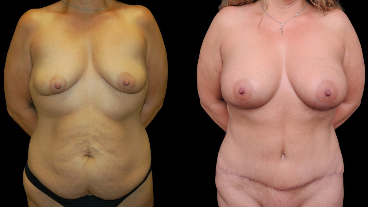 Mommy Makeover Before & After Gallery - Patient 358824 - Image 1