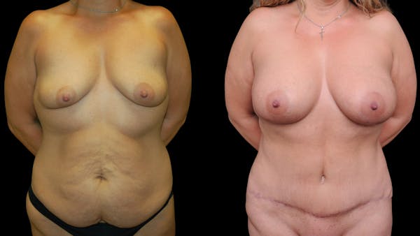 Mommy Makeover Before & After Gallery - Patient 358824 - Image 1