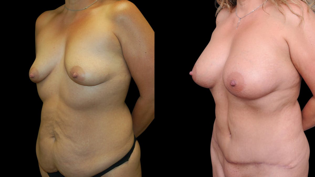 Mommy Makeover Before & After Gallery - Patient 358824 - Image 2