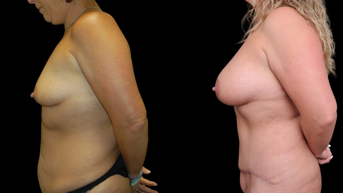 Mommy Makeover Before & After Gallery - Patient 358824 - Image 3