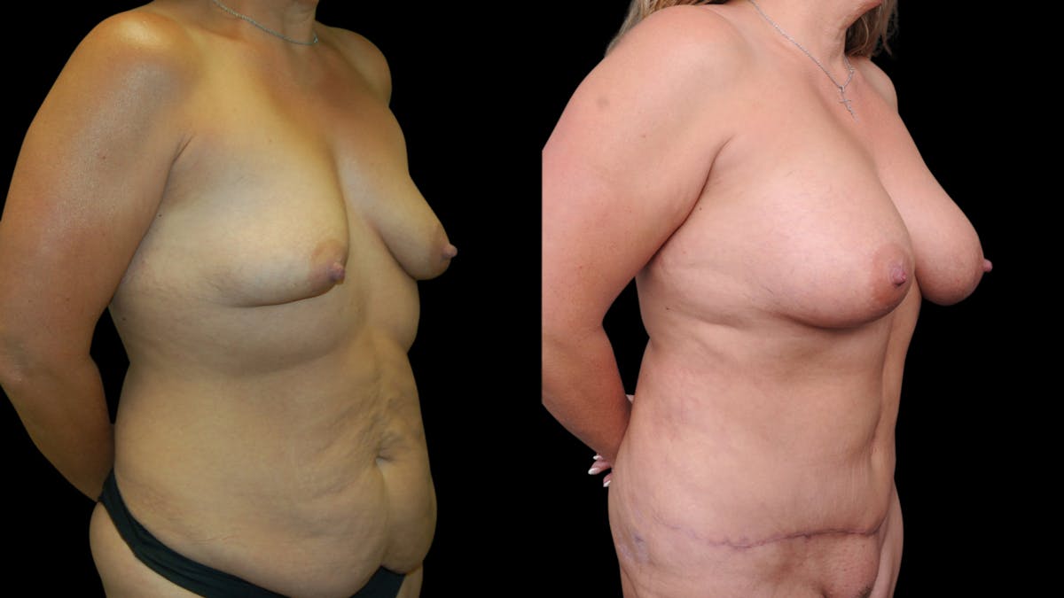 Mommy Makeover Before & After Gallery - Patient 358824 - Image 4